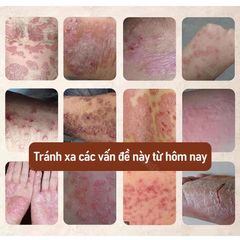 Kem Bôi Da NHẬT BẢN Dứt Điểm Viêm Da Cơ Địa Nấm Ngứa Ghẻ Nước Cực Kì Hiệu Quả
