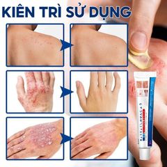 Kem Bôi Da NHẬT BẢN Dứt Điểm Viêm Da Cơ Địa Nấm Ngứa Ghẻ Nước Cực Kì Hiệu Quả