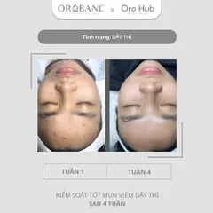 Combo Orobanc Cải Thiện Mụn, Phục Hồi Da Nhạy Cảm - Phyto B3 Acne Ampoule + Ectoin B5 Serum + Cica B3 Cream