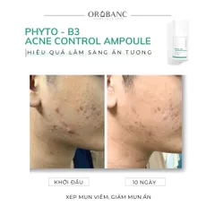 Combo Orobanc Cải Thiện Mụn, Phục Hồi Da Do Cort - Phyto B3 Acne Ampoule 20ml + Cica Peptide Serum 30ml