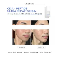 Combo Orobanc Cải Thiện Mụn, Phục Hồi Da Do Cort - Phyto B3 Acne Ampoule 20ml + Cica Peptide Serum 30ml