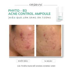 Combo Orobanc Cải Thiện Mụn, Phục Hồi Da Do Cort - Phyto B3 Acne Ampoule 20ml + Cica Peptide Serum 30ml