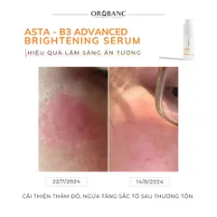 Combo Orobanc Dưỡng Sáng, Mờ Thâm, Ẩm Mịn Phục Hồi Da - Cica Peptide Serum 30ml + Asta B3 Serum 30ml