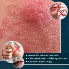 1 Hộp Kem Bôi Nấm Ngứa Viêm Da Cơ Địa NHẬT BẢN Hắc Lào, Tổ Đỉa, Vẩy Nến, Á Sừng, Lang Ben