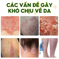Kem bôi da liễu nhật bản Tái Tạo Da Hư Tổn Do Hắc Lào, Tổ Đỉa, Ghẻ Nước, Bỏng Nhiệt, Côn Trùng Cắn nấm glycerin Serum Mụn Diếp