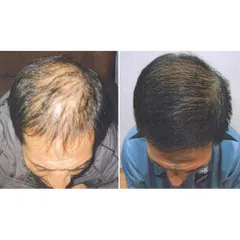 TINH DẦU BƯỞI GIẢM RỤNG KÍCH THÍCH MỌC TÓC MƯỢT TÓC 759952