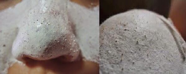 Combo 2 hủ Gel lột mụn PEELING PACK hút sạch nhân mụn, làm sạch mụn cám 760631