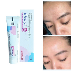 Gel Giảm Mụn Klenzit Ms 15g - Hỗ Trợ Giảm Mụn Trứng Cá và Mụn Ẩn, Làm Sáng Da và Ngăn Ngừa Viêm
