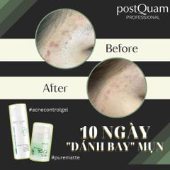 Kem dưỡng PostQuam Pure Matte (Q13) giảm viêm sưng, thâm cho da mụn nặng 50ml [hàng nhập khẩu]