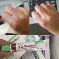 Kem Gentacin được sử dụng để giảmcác vết sẹo thâm, sẹo rỗ, sẹo mụn, giúp làm mờ sẹo và thúc đẩy làm lành da 10g