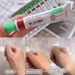 Kem Gentacin được sử dụng để giảmcác vết sẹo thâm, sẹo rỗ, sẹo mụn, giúp làm mờ sẹo và thúc đẩy làm lành da 10g