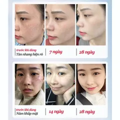 Kem trắng da và xóa tàn nhang Kem nám tàn nhang 20g kem dưỡng trắng da mặt Hiệu quả làm mờ thâm nám tàn nhang