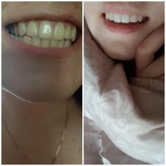 Miếng Dán Trắng Răng 3D White Teen Whitening Strip