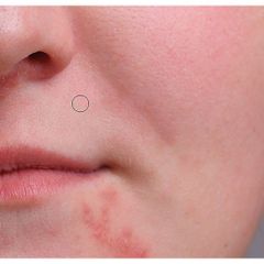 Cây nặn mụn inox MiraCulous Pimple Remover Tool Cao cấp Hàn Quốc - Hàng chính hãng 784934