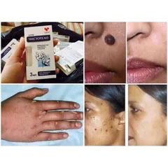 Gel Dvelinil giảm nốt ruồi, mụn cóc, mụn thịt, sẹo lồi – Nga 788385