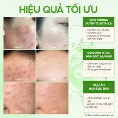 Serum Chấm Mụn GUO - Cải Thiện Mụn Hiệu Quả Với AHA 2.2%, BHA 1%, Sulfur - Sản Phẩm Chăm Sóc Da Nhạy Cảm 10ml/30ml