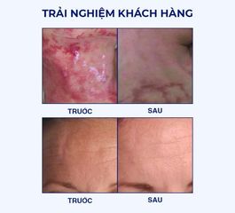 (Mỹ) Gel Làm Mờ Sẹo Rejuvaskin & Miếng Dán Sẹo Silicone Chính Hãng Hỗ Trợ Cải Thiện Sẹo Sau Phẫu Thuật, Sẹo Sau Chấn Thương, Sẹo Lồi