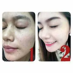 Kem hỗ trợ mụn thâm BioAqua 30ml 792812