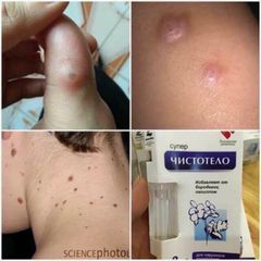 Gel Dvelinil giảm nốt ruồi, mụn cóc, mụn thịt, sẹo lồi – Nga 793318