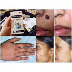 Gel Dvelinil giảm nốt ruồi, mụn cóc, mụn thịt, sẹo lồi – Nga 793318