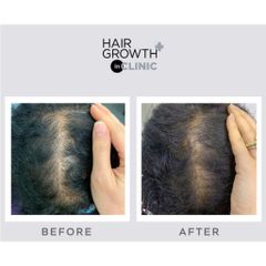 Viên Uống Hỗ Trợ Kích Thích Mọc Tóc Nam Nữ Nourkrin Hair Growth+ InClinic Hộp 90 Viên 794651