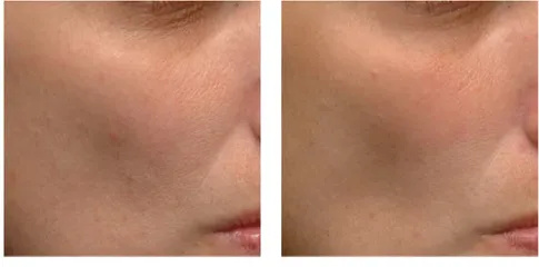 Pharmaform AZE-LIFT SERUM serum kiểm soát dầu thừa giúp thu nhỏ lỗ chân lông và cải thiện tình trạng mụn 