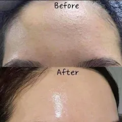 Kem Giảm Mụn Ẩn Và Thâm Gamma Megaduo Plus Gel 15gr