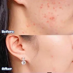 Kem Giảm Mụn Ẩn Và Thâm Gamma Megaduo Plus Gel 15gr