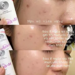 Kem Giảm Mụn Ẩn Và Thâm Gamma Megaduo Plus Gel 15gr