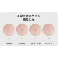 Máy Đốt Nốt Ruồi Mụn Thịt | Tàn Nhang 9 Cấp Độ Máy Đốt Nốt Ruồi Mini.