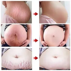 Xóa Sẹo Mang Thai Kem Rạn Da Kem Làm Săn Chắc Cơ Thể 40g Kem rạn da chống rạn da cho bà bầu làm mờ vết rạn sau sinh