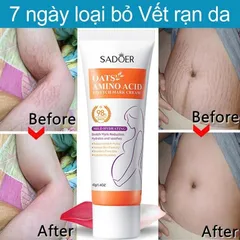 Kem xóa rạn da sau sinh mờ thâm sáng da chỉ sau 7 ngày, cải thiện sẹo rạn lâu năm, dưỡng ẩm phục hồi làn da