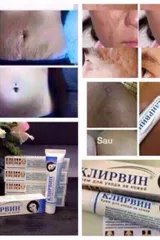 Kem giảm sẹo thâm, sẹo lồi, sẹo lõm Nga Klirvin 25ml 809395