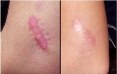 Kem giảm sẹo thâm, sẹo lồi, sẹo lõm Nga Klirvin 25ml 809395
