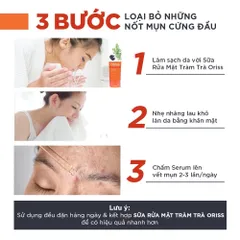 Serum Mụn Oriss Hỗ Trợ Ngừa Mụn Phục Hồi Da Mờ Thâm Thu Nhỏ Lỗ Chân Lông Chai 10ml