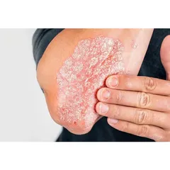 DM vả y nến ng ứa h ắc l ào la ng b en nấm kẽ tay kẽ chân