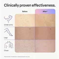 Máy Triệt Lông Laser Cao Cấp 4 Đầu Braun IPL 7, Model: Braun Skin i-Expert  PL7243, PL5267, PL5257, Chính Hãng