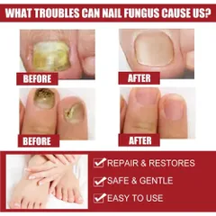 Tinh chất nấm móng Serum Tẩy Nấm Móng Tay Chân Loại Bỏ Nấm Móng Dưỡng Móng Phục Hồi Móng