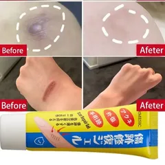Kem xóa sẹo loại bỏ hiệu quả các vết sẹo cũ sẹo sẹo phẫu thuật, phục hồi và làm sáng các vết rạn da khi mang thai