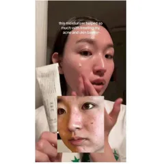 Kem dưỡng mụn gom cồi mụn Tazoretin xanh lá và phục hồi sau mụn 345 
