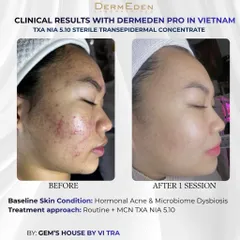 Tinh chất DermEden Mela-Protocole Hyperpigmentation TXA NIA 5.10 (5x5ml)
