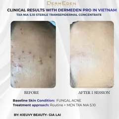 Tinh chất DermEden Mela-Protocole Hyperpigmentation TXA NIA 5.10 (5x5ml)