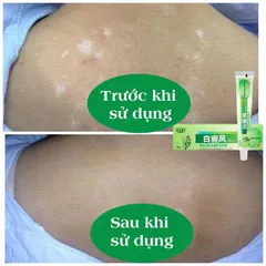 Kem bôi rối loạn sắc tố da - bạch biến cực hiệu quả