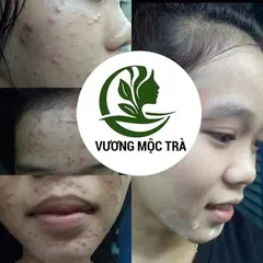 Serum tái tạo da CAO CẤP VƯƠNG MỘC TRÀ chai 30ml chuyên mụn, nám, tàn nhang, sẹo nhanh bong cực hiệu quả