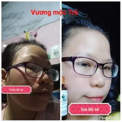 Tặng bột, Serum tái tạo da CAO CẤP VƯƠNG MỘC TRÀ chai 50ml chuyên mụn, nám, tàn nhang, sẹo nhanh bong cực hiệu quả