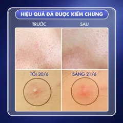 Nước Hoa Hồng Dưỡng Da Ngăn Ngừa Mụn Meishoku Nhật Bản