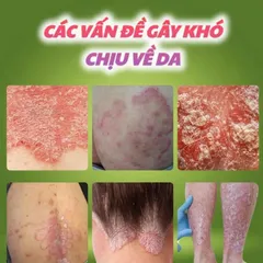 Kem Bôi Da Liễu Heyoul Hàn Quốc, Hỗ Trợ Giảm Ngứa Da Á Sừng Tổ Đỉa, Làm Dịu Da Nhạy Cảm 20g