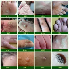 (Nhật Bản) Kem loại bỏ mụn thịt trên cổ, da thừa, mụn cóc dạng sợi, mụn nhỏ ở vùng nách, dưỡng sáng
