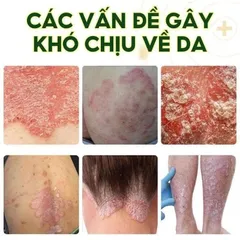 2 TUÝP TẶNG 1 Kem Bôi Nấm Ngứa Viêm Da Cơ Địa NHẬT BẢN Hắc Lào, Tổ Đỉa, Vẩy Nến, Á Sừng, Lang Ben Hiệu Quả