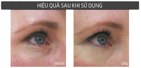 Kem Dưỡng Mắt Shiseido Ultimune Eye Power 15ml - Hỗ Trợ Giảm Thâm Quầng, Nếp Nhăn, Chăm Sóc Da Nhạy Cảm quanh Mắt